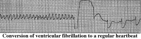 Defibrillation